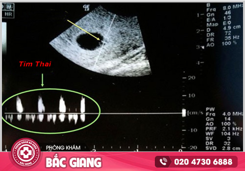 Dấu hiệu không có tim thai - Hướng xử lý an toàn cho mẹ