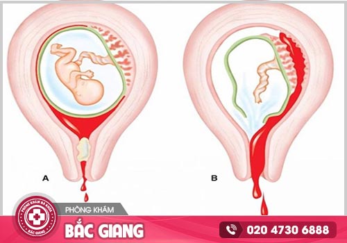 Hút thai bị sót phải làm gì?
