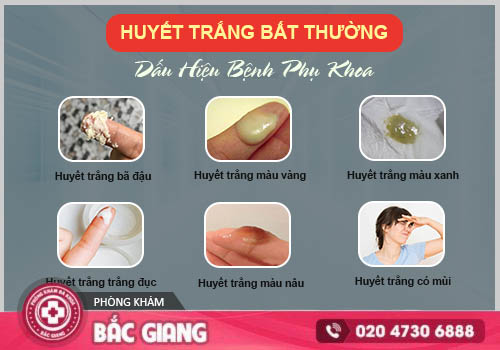 Tổng quan về bệnh huyết trắng mà chị em cần lưu ý