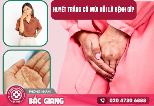 huyết trắng có mùi hôi