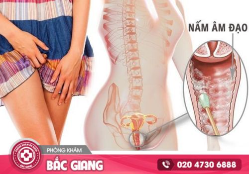 Nấm âm đạo nguyên nhân và cách điều trị