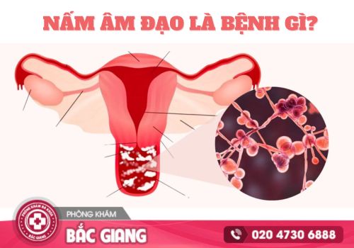 Nấm âm đạo: Nguyên nhân và dấu hiệu nhận biết