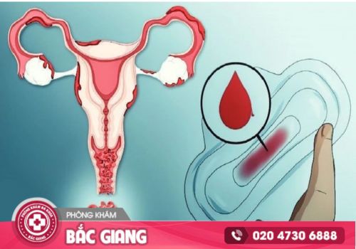 Thận trọng với hiện tượng rong kinh ở nữ giới hiện nay