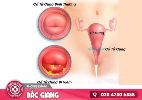 Một số thông tin tổng quan về bệnh viêm cổ tử cung