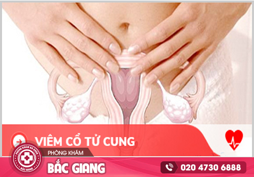 Tìm hiểu về viêm cổ tử cung trước khi bệnh ảnh hưởng tới sức khoẻ