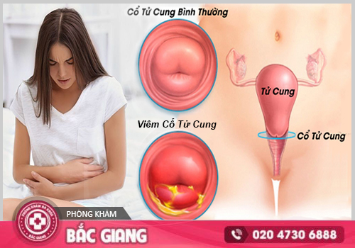 viêm cổ tử cung
