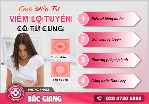 Điều trị viêm lộ tuyến cổ tử cung ở đâu? Chữa trị bằng cách nào?