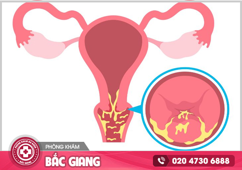 Viêm nội tuyến cổ tử cung là gì? Cách chữa trị ra sao?