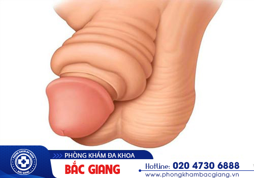 Bao quy đầu bị sưng do đâu? Cách chữa trị