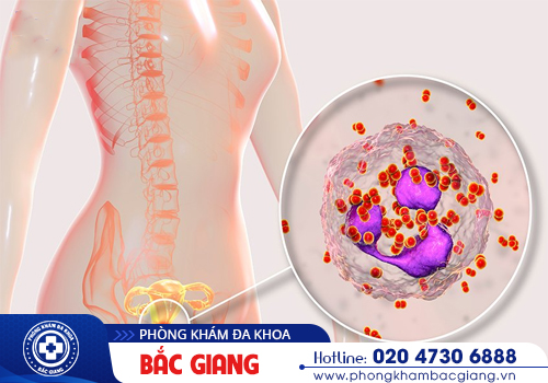 Bệnh lậu ở nữ giới - Chớ nhầm lẫn với bệnh phụ khoa thông thường