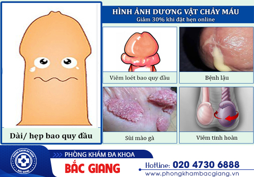 Dương vật chảy máu: Nguyên nhân, Biến chứng và Địa chỉ điều trị