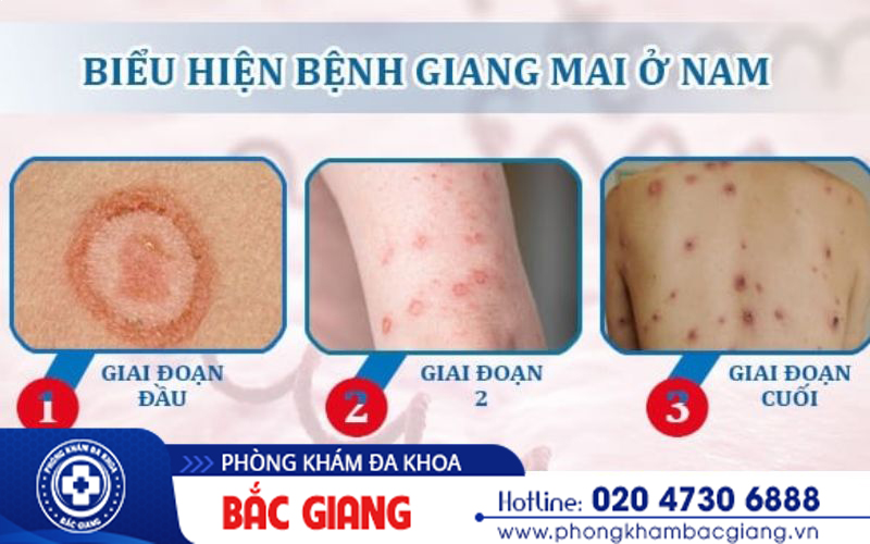 loét giang mai ở dương vật