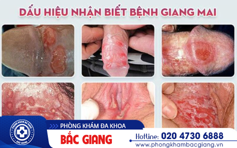 xét nghiệm máu có phát hiện giang mai không