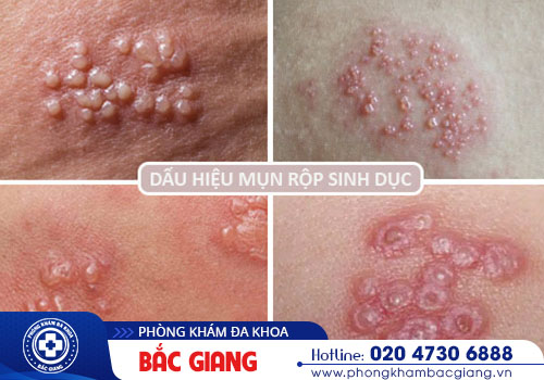 Dương vật nổi mụn rộp là bị gì?