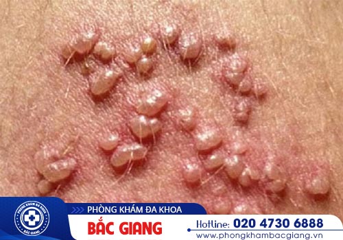 Điểm danh những bệnh nam khoa thường gặp hiện nay