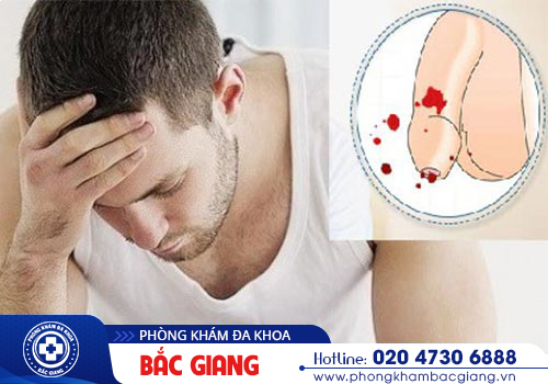 Dương vật chảy máu: Nguyên nhân, Biến chứng và Địa chỉ điều trị