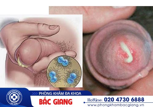 Dương vật chảy mủ có sao không?
