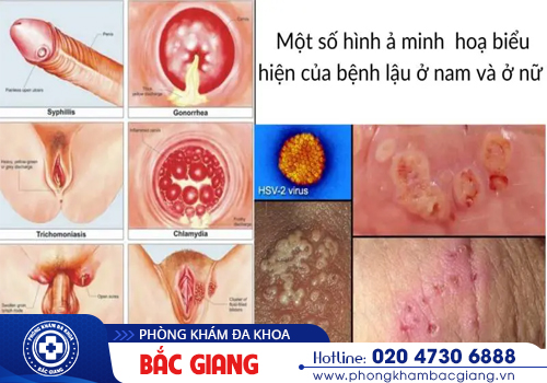 Giá xét nghiệm bệnh lậu hết bao nhiêu tiền?