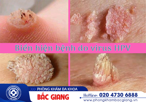 Giá xét nghiệm HPV? Xét nghiệm ở đâu uy tín, an toàn