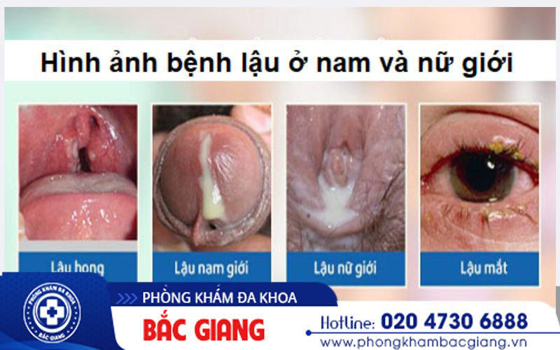 xét nghiệm lậu cầu