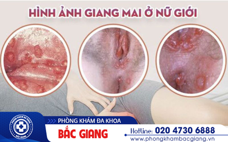 Biểu hiện ban đầu của bệnh giang mai