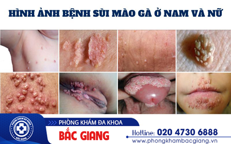 Thuốc chữa sùi mào gà giai đoạn đầu