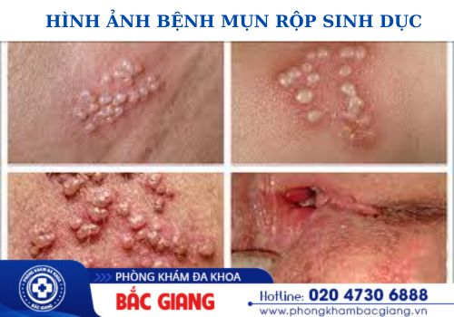 Nhận biết dấu hiệu ban đầu của mụn rộp sinh dục