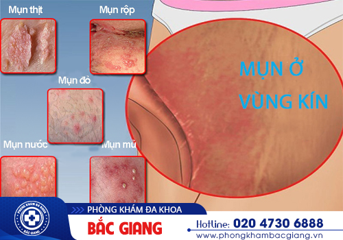 Mụn vùng kín là dấu hiệu bệnh gì? Khắc phục như thế nào?