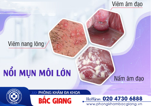 Mụn vùng kín là dấu hiệu bệnh gì? Khắc phục như thế nào?
