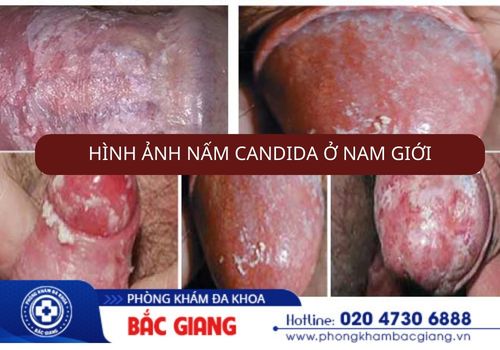 Nấm Candida ở nam giới 