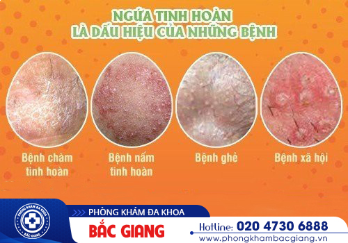 Ngứa bìu tinh hoàn - Những điều nam giới chưa biết