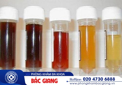 Nước tiểu có màu lạ cảnh báo điều gì? Có nguy hiểm không?