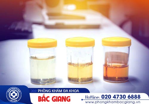 Nước tiểu có màu lạ cảnh báo điều gì? Có nguy hiểm không?