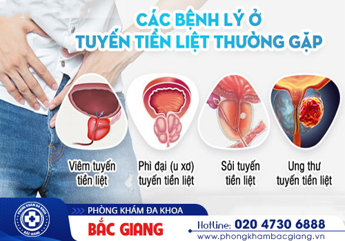 Địa chỉ khám tuyến tiền liệt nam giới uy tín tại Bắc Giang