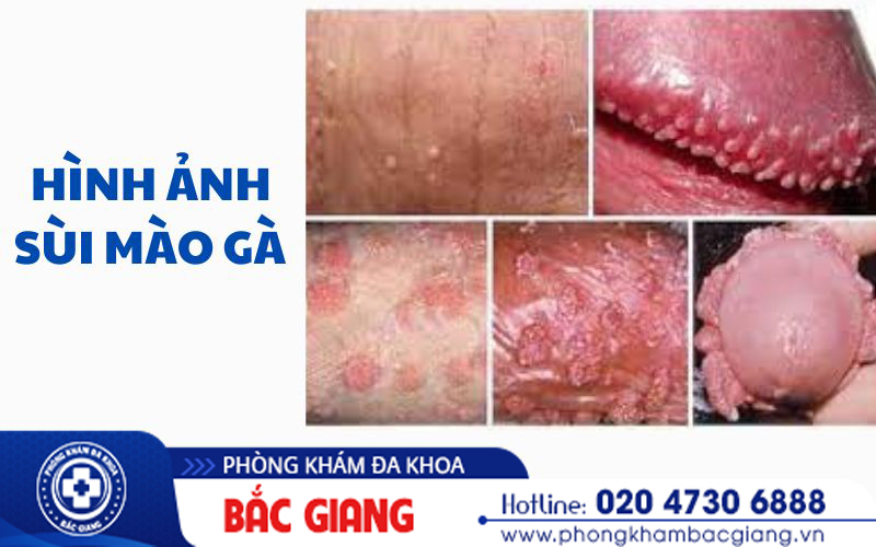 sùi mào gà ở đầu cu