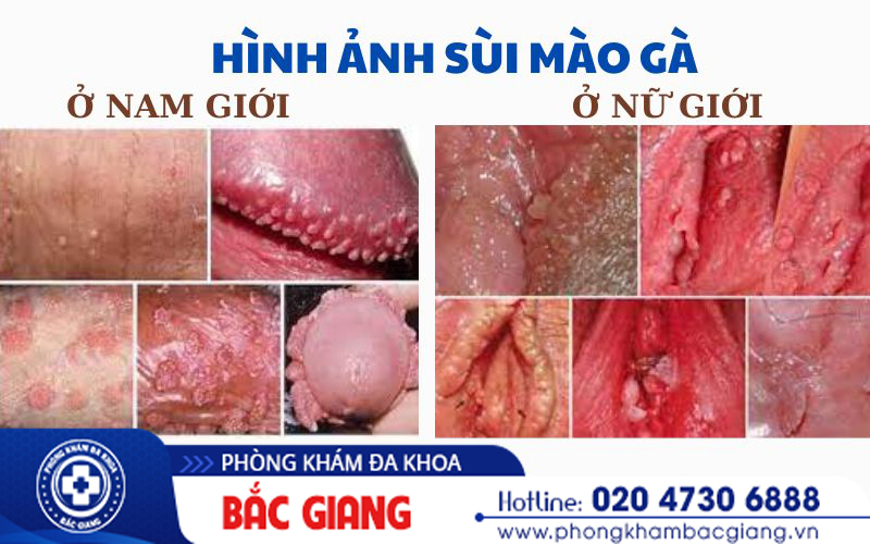 Thuốc chữa sùi mào gà giai đoạn đầu