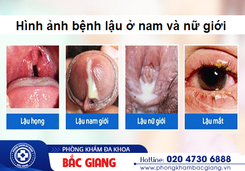 Xét nghiệm bệnh lậu bằng phương pháp nào? Nên thực hiện ở đâu?