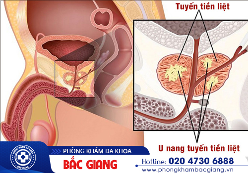 Nam giới cần thận trọng với u nang tuyến tiền liệt