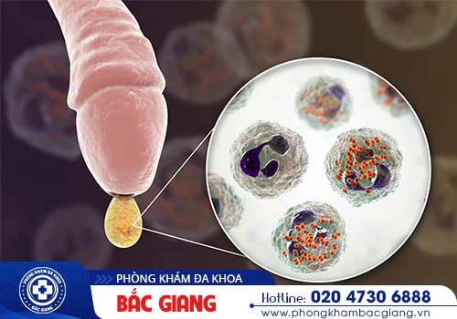 Vùng kín bị chảy mủ sau khi quan hệ là bị gì?
