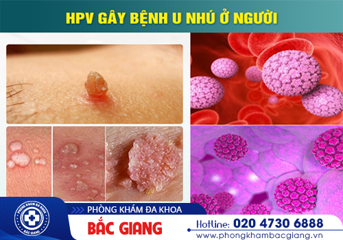 Xét nghiệm HPV là gì? Tại sao nó lại quan trọng?