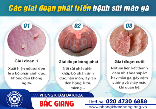 Xét nghiệm sùi mào gà ở đâu Bắc Giang? Chi phí bao nhiêu?