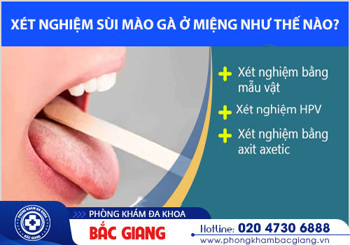 Xét nghiệm sùi mào gà ở miệng như thế nào?