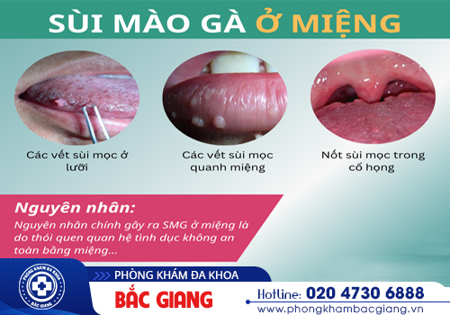 Xét nghiệm sùi mào gà ở miệng như thế nào?