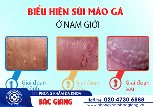 Xét nghiệm sùi mào gà ở nam giới nên thực hiện khi nào?